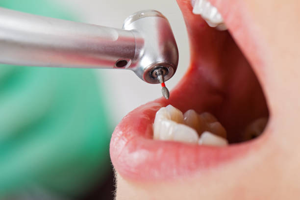 Best Emergency Root Canal Therapy in Imperial, NE